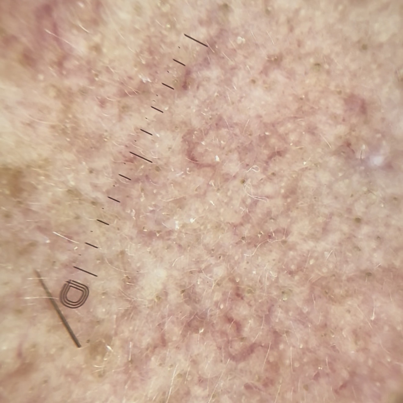 Dermatoskopia skóry z widocznymi przebarwieniami od pigmentów Malassezia