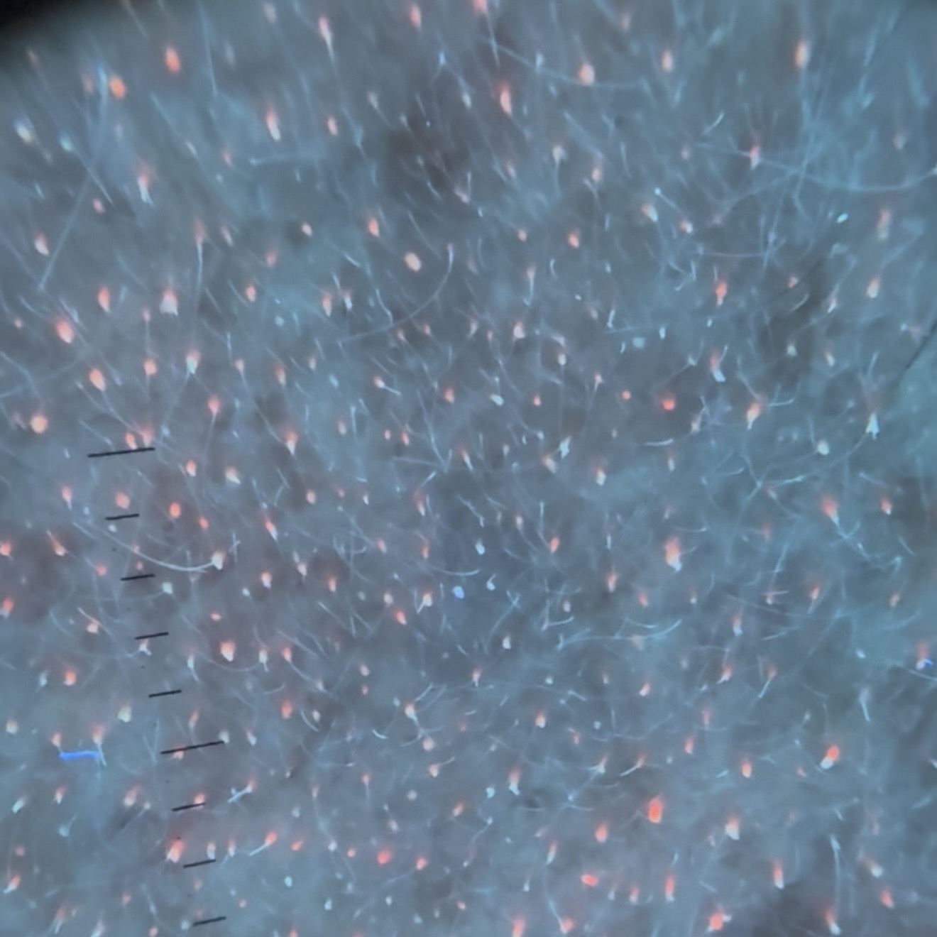 Fluorescencja Malassezia w lampie Wooda — ujęcie 2
