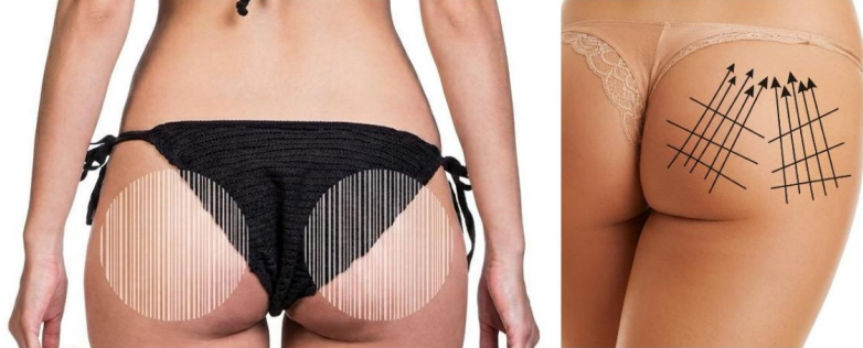 Protokół HIFU pośladków z zaznaczeniem strefy „banana roll” i wektorów liftingu push-up