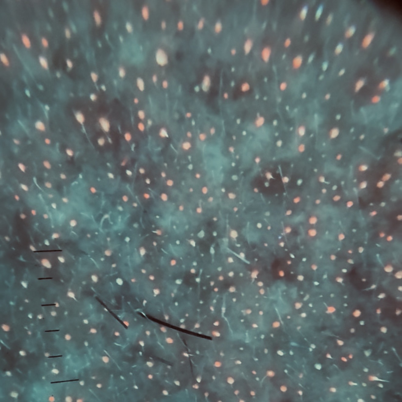 Fluorescencja Malassezia w lampie Wooda — ujęcie 1